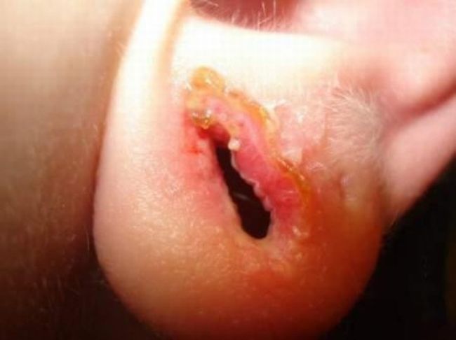 piercing-infection-17