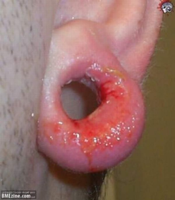 piercing-infection-20