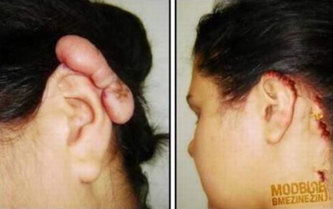 piercing-infection-22