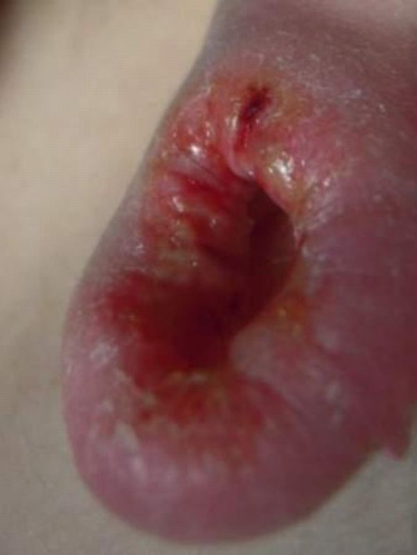 piercing-infection-24