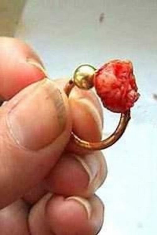 piercing-infection-27