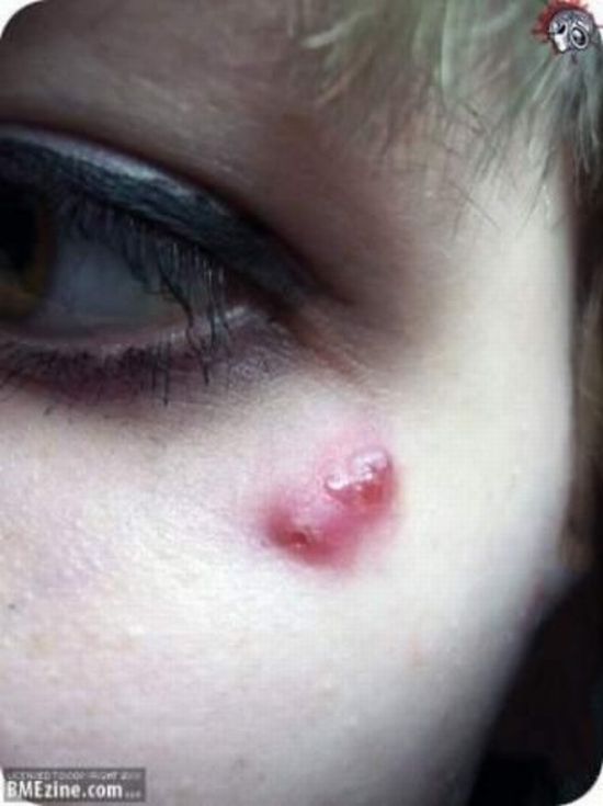 piercing-infection-29