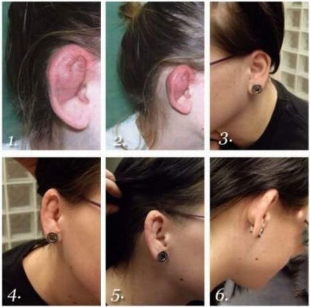 piercing-infection-33