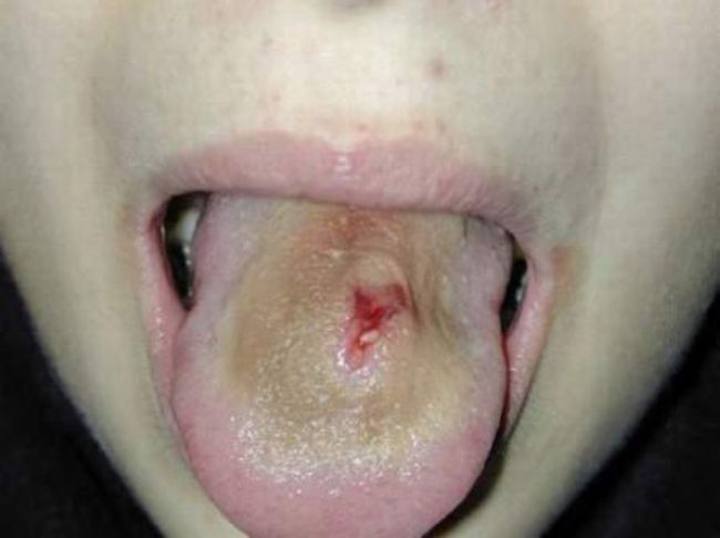 piercing-infection-34