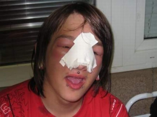 piercing-infection-41