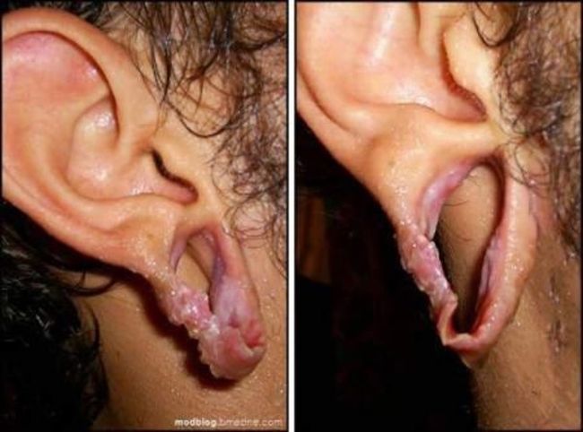 piercing-infection-42