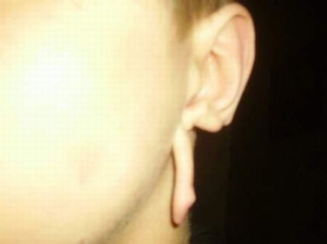 piercing-infection-44