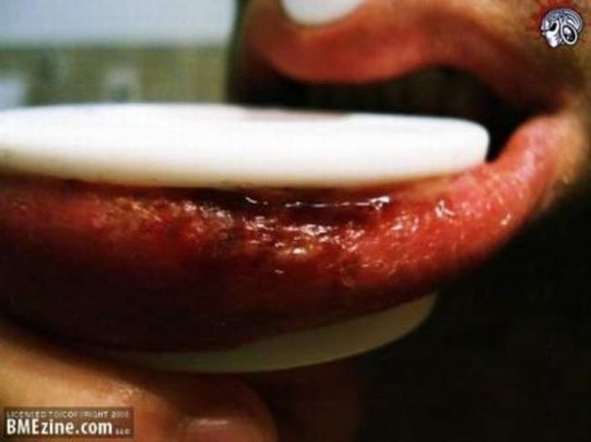 piercing-infection-45