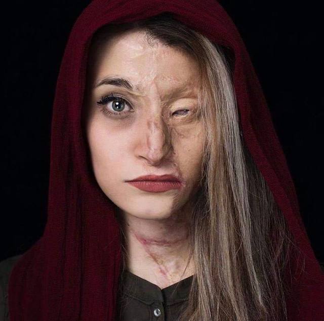 femme-retire-hijab-aspergee-acide-iran