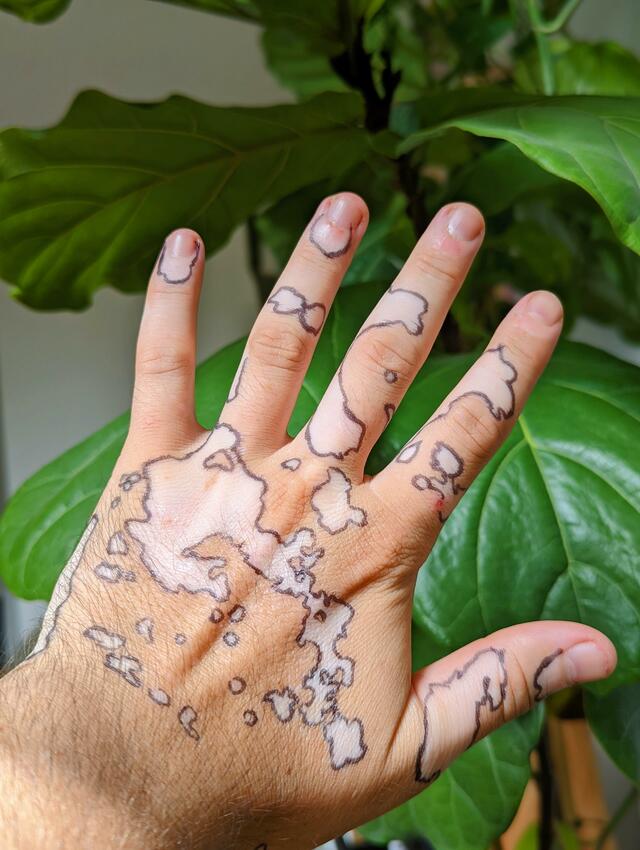 vitiligo-carte-imaginaire
