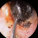 miniature pour Une graine dans l'oreille