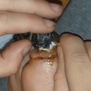 miniature pour Il s'arrache son doigt de pied gelé