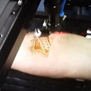 miniature pour Un tatouage au laser