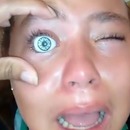 miniature pour Un oeil de poupée bloqué dans la cornée d'une fille