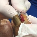miniature pour Le podologue lui arrache un énorme ongle incarné (Gore)