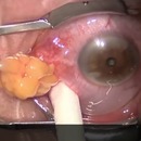 miniature pour Opération d'extraction d'un kyste dans l'oeil