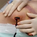 miniature pour Vidage d'un énorme hématome dans la jambe